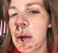 Cyclist on the road to recovery after horrific crash in Baughurst