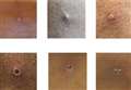 What is monkeypox and how do you catch it? 