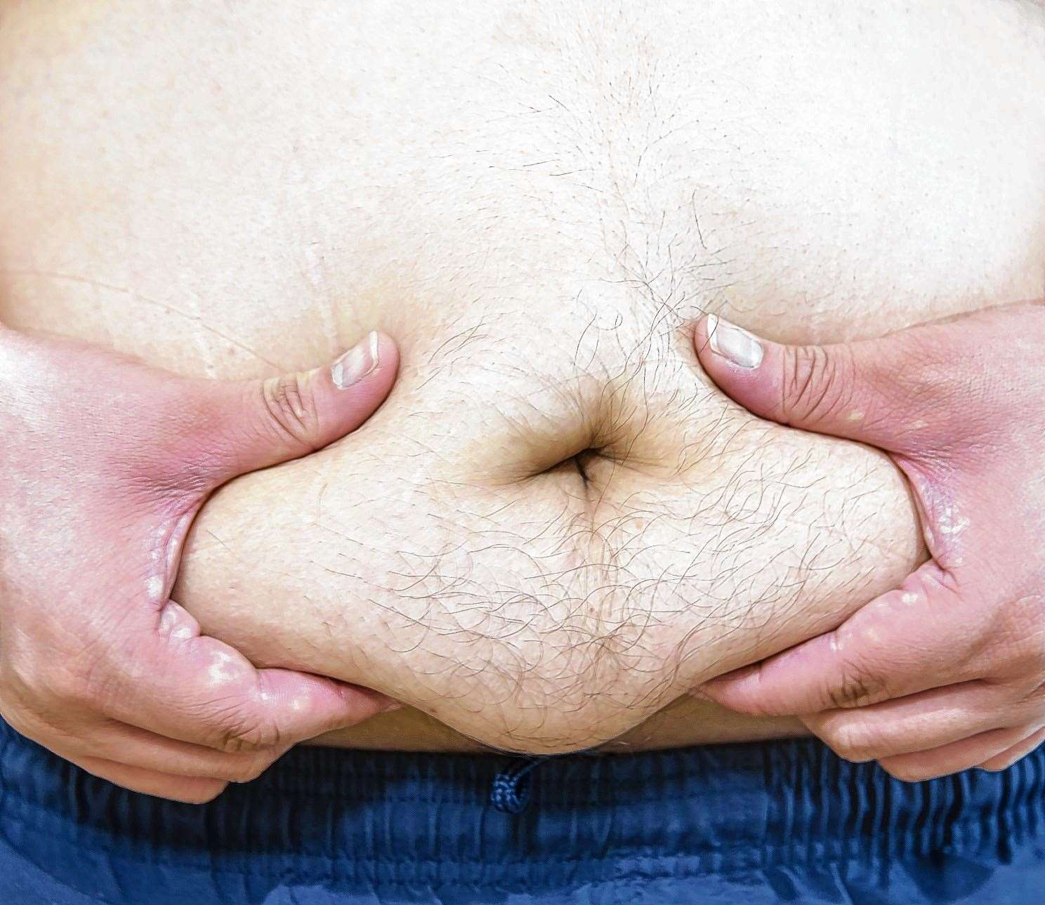 Obesity