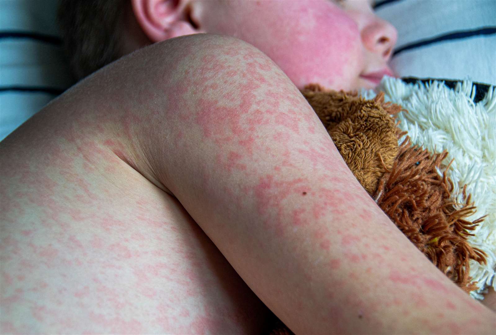 A child with measles